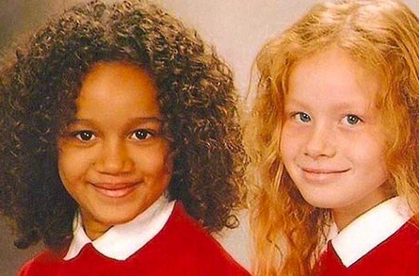  The twin girls who were born with different skin colors are already 25 years old