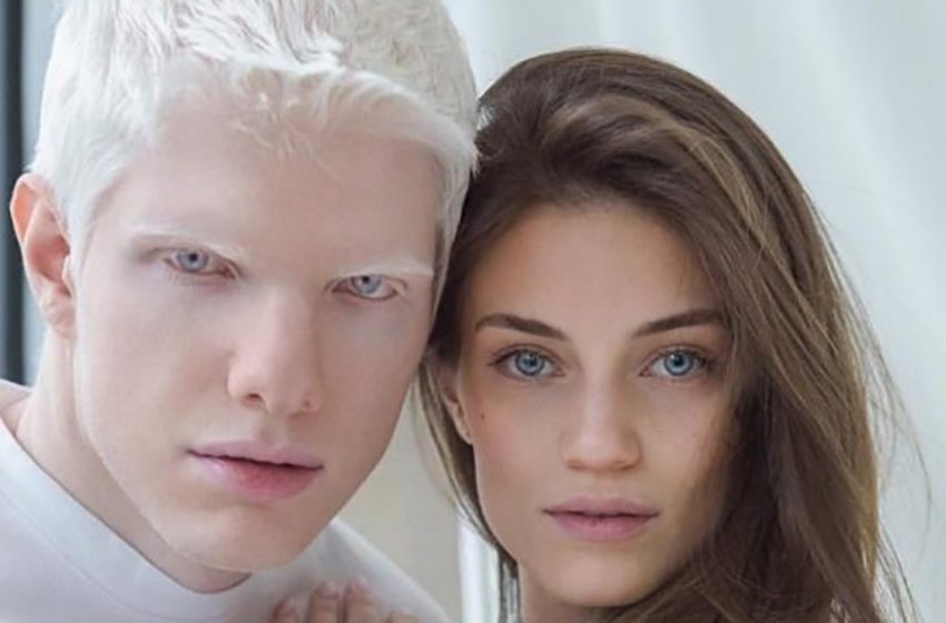  ‘Like a Little Angel’: What the Son of a Georgian Model and the World’s Most Handsome Albino Looks Like
