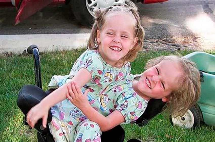  The Siamese Twins Were Separated When They Were 4 Years Old: Look What 18-year-old Girls Look Like Now?