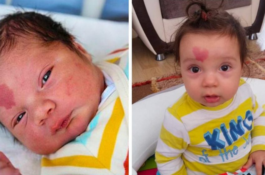  A Baby With a Birthmark On His Forehead In The Form Of a Heart Is Already 6: What Does He Look Like Now?